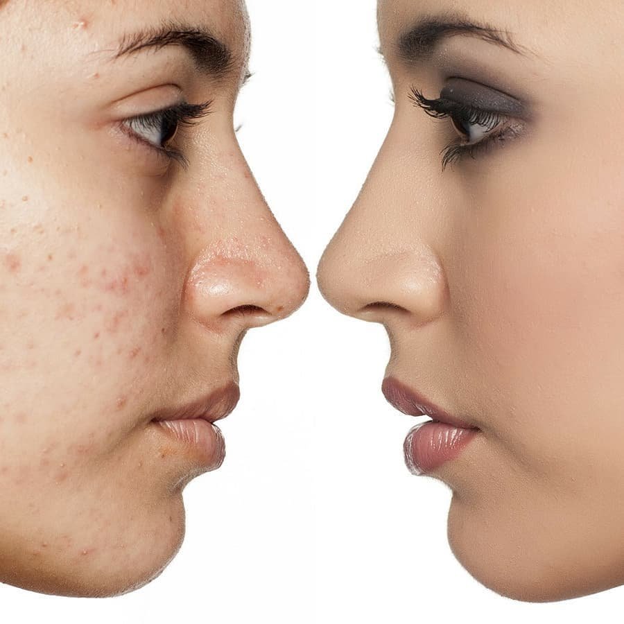 Acne laser treatment for disinfecting pus-filled acne