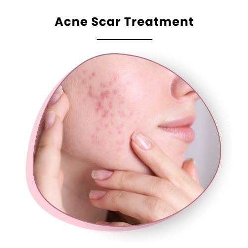 Acne Scar Treatment in Noida