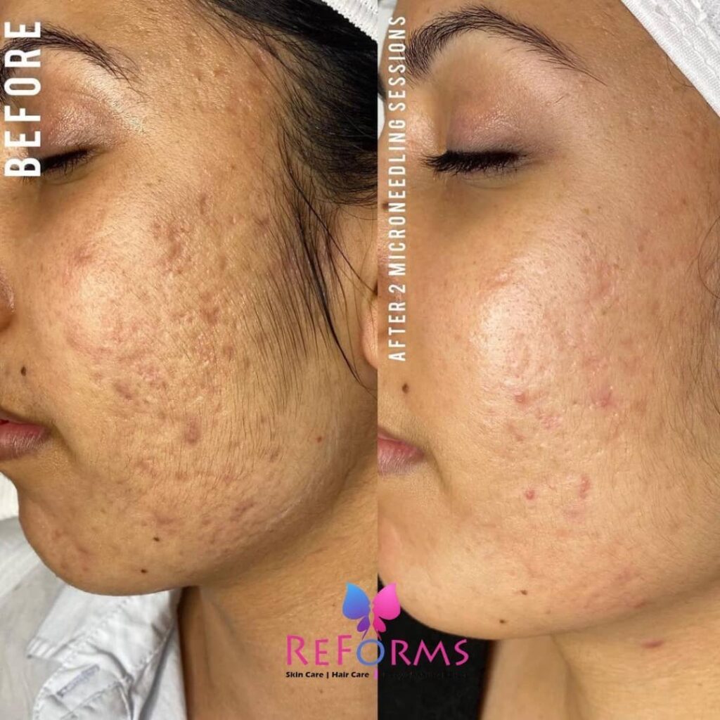 Microdermabrasion session for gentle skin rejuvenation