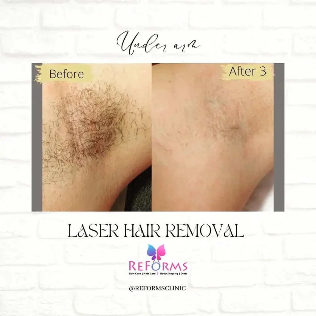laser-hair-removal-final