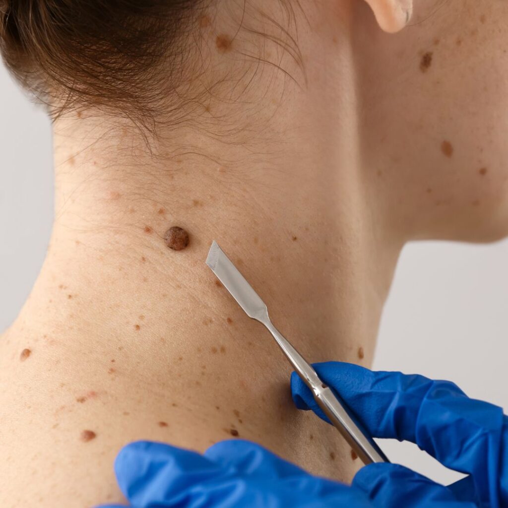 mole removial treatment in noida