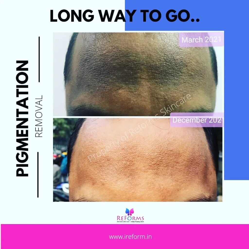 Skin Pigmentation Treatment in Noida